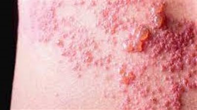 وصفات منزلية متاحة لعلاج الحزام الناري