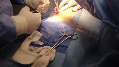 إنقاذ حياة طفلة مصابة بفيروس كورونا تعاني من انفجار بالزائدة الدودية بمستشفى سوهاج العام