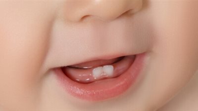 أضرار الأطعمة المغلفة على أسنان الأطفال (دراسة)