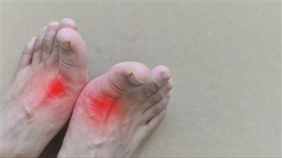 إليك أبرز المعلومات عن مرض 