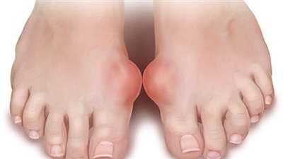 تعرف على أسباب الإصابة بالنقرس عند النساء