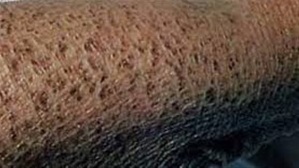  مرض السمكية وأثره