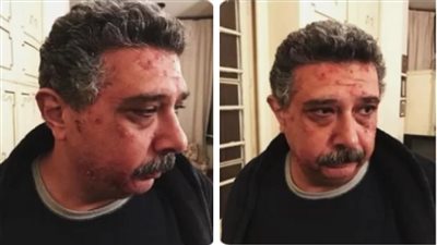 حقيقة ظهور الفنان ماجد الكدواني مصاباً بطفح جلدي (صورة)