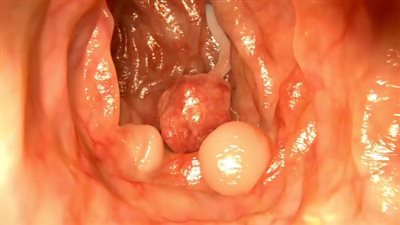 3 أمراض تنذر بالإصابة بسرطان القولون.. تعرف عليهم