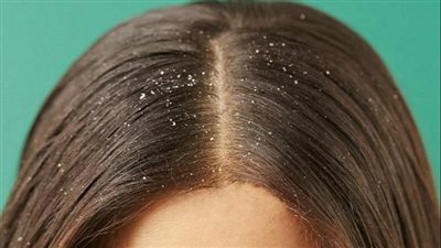 خبراء يحذرون من سبب خفي يزيد من قشرة الشعر