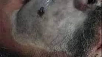 أصاب سمير غانم قبل وفاته.. طبيب مناعة يوضح طرق الوقاية من مرض الفطر الأسود (فيديو)