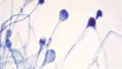باحث في علم الفيروسات يكشف سبب اقتران الإصابة بـ