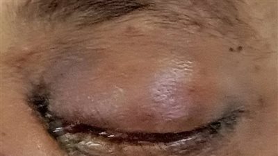 ننشر التقرير الطبي لحالة المشتبه بإصابته بالفطر الأسود في الغربية