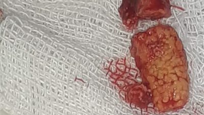 فريق طبي ببنها الجامعي ينجح في استئصال حصوة أسفل الفك لشاب (صور) 