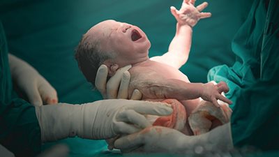 نجاح ولادة توأم لأم مصابة بـ