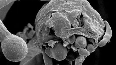 الصحة العراقية تنفى تسجيل حالات إصابة بالفطر الأسود