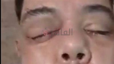 زوجة مصاب بالفطر الأسود بطنطا: 