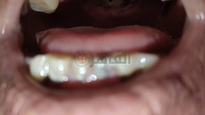 أسوان تسجل أول حالة إصابة بالفطر الأسود (صورة)