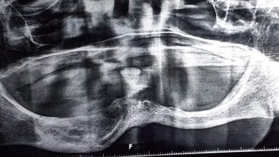 فريق طبي بمستشفى بنها الجامعي يجري جراحة دقيقة بالفم لمريضة مسنة (صور) 