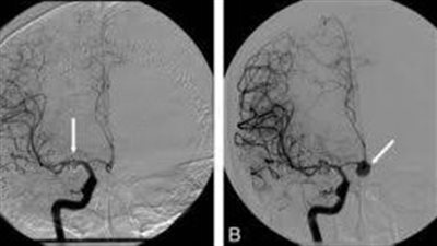 أطباء مستشفى التأمين الصحي الشامل ببورسعيد ينقذون حالتي 