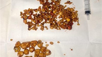 فريق طبي ينجح في استخراج حصوات لمريض مصاب بانسداد القناة المرارية بقنا