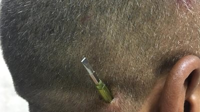 مستشفى سوهاج الجامعي ينجح في استخراج مفك طوله 10 سم من رأس مواطن  