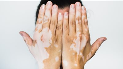 العالم يحتفل باليوم العالمي للبهاق 25 يونيو