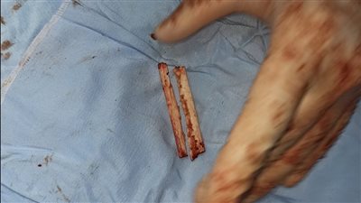 استئصال ورم سرطاني مُتشعب من جسد طفلة في الشرقية (صور)