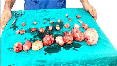 إخراج 43 ورما من رحم سيدة بالإسكندرية.. وعضو بالفريق الطبي: العملية استغرقت 4 ساعات وهناك فرصة للحمل