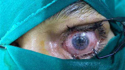 إجراء عمليتين جراحيتين لزراعة قرنية كاملة بمستشفى الرمد في المنيا