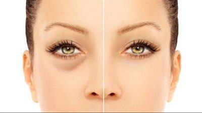  أفضل وصفات الشاي للعناية بالبشرة خلال عيد الأضحى.. تعرف عليها 