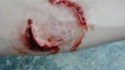 كلب مسعور يعقر 10 أطفال بقرية دجوى ببنها 