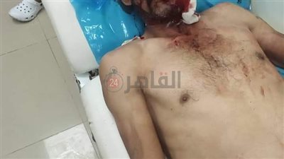 جروح بالرأس والوجه.. أبناء يعتدون بالأسحلة البيضاء على زوج أمهم بقرية سرابيوم بالإسماعيلية