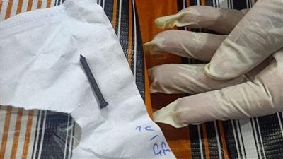 استخراج مسمار من معدة طفل في مستشفى منيا القمح بالمركزي بالشرقية (صور)