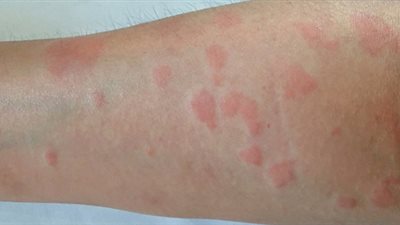 دراسة أمريكية تكشف السبب الجذري للإصابة بمرض الذئبة الحمراء