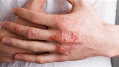 أعراض الإكزيما الشائعة.. تعرف عليها