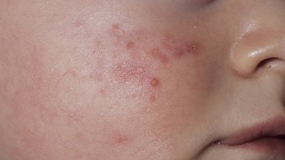 بعد انتشار الهربس.. تعرف على أخطر الأمراض الجلدية إصابة للأطفال