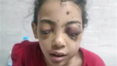 والد أحد الأطفال المصابين بواقعة عرس الخانكة: بنتى تبكي ليلًا ونهارًا لفقدنها البصر وابنى شظايا الخرطوش ملأت جسده