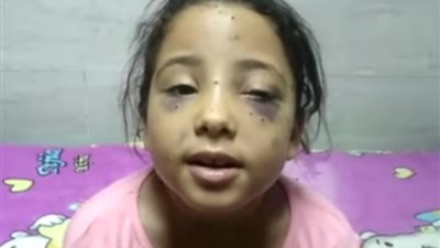 والد طفلة مصابة بقصور فى القرنية بحادث عرس الخانكة: شاهدت ابنتى ودماءها تسيل والخرطوش اخترق جفن عينيها