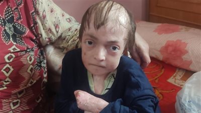 يعاني من مرض نادر وأمه مصابة بداء الفيل.. شاب بالمنوفية يستغيث للتكفل بعلاجهما «فيديو»