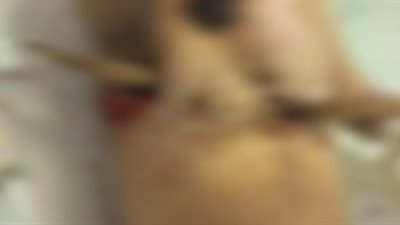 فريق طبي ينجح في استخراج جسم خشبي اخترق جسد شخص بكفر الشيخ 