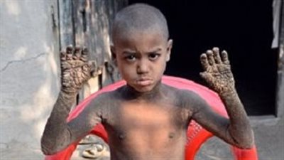 الروح حية والجسد متحجر.. أغرب الأمراض حول العالم