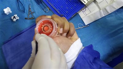 نجاح أول عملية زراعة قرنية بمستشفى رمد المنصورة | صور