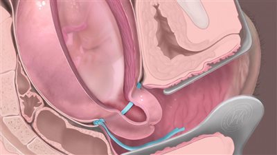 دار الإفتاء المصرية توضح حكم عمليات ربط الرحم لمنع الحمل