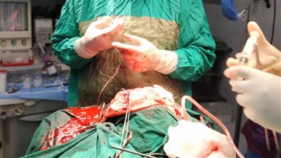 فريق طبي متخصص في مستشفى خاص بـ الغربية ينجح في استئصال ورم من المخ 