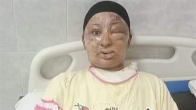 أشعل النيران بجسدها أمام طفلها.. زوجة تروي تفاصيل اعتداء زوجها عليها بالإسكندرية