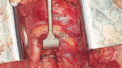 نجاح جراحة معقدة لفتاة عانت من اختناق بالقصبة الهوائية بـ مستشفى أبو خليفة 