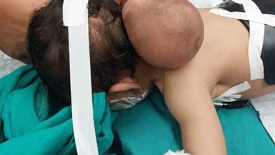 حالة نادرة.. مستشفى ملوي التخصصي ينجح في استئصال كيس سحائي بالمخ