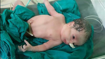 ولادة قيصرية لمصابة بفيروس كورونا بمستشفى الحجر الصحي بكفر الدوار | صور