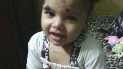 أم تستغيث لعلاج ابنتها المصابة بورم في الجلد: ياريس نفسي تخف قبل ما تصبح شابة │ صور