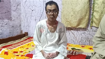 شاب أسواني يستغيث بالسيسي بسبب الفقاعات الوراثية: نفسي أعيش حياة كريمة يا ريس