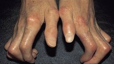 ما هو تيبس الجلد وعلاجه ؟...خبير مناعة يجيب