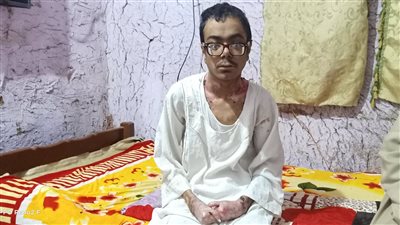 استجابة لموقع القاهرة 24.. رئاسة الوزراء تتكفل بعلاج صاحب مرض الفقاعات الوراثية