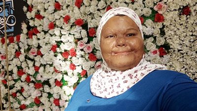 مصابة حروق من الدرجة الثالثة تتحول لأيقونة دعم نفسي 