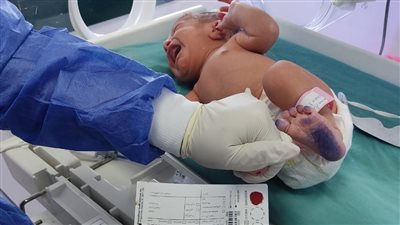 الصحة: فحص 98 ألف طفل حديث الولادة للكشف المبكر عن الأمراض الوراثية